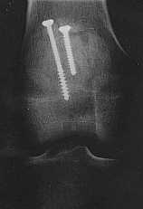 broken knee X-ray, 3.9k